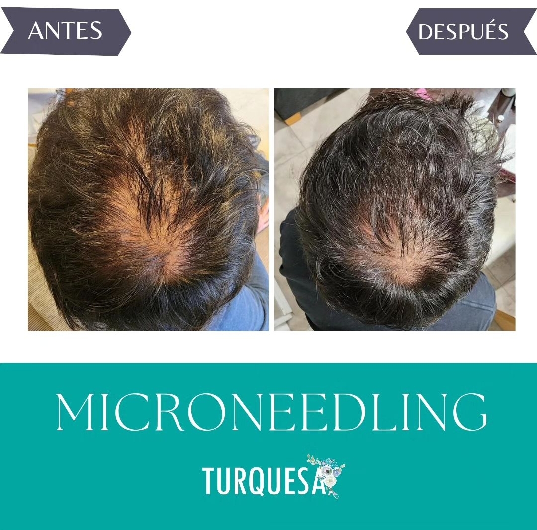 Antes y después de tratamiento de Microneedling Capilar en Estetica Turquesa